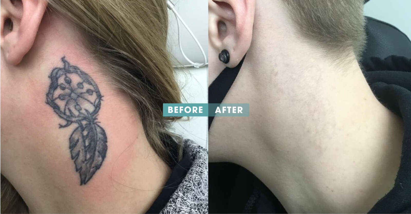 tattoo removal cost